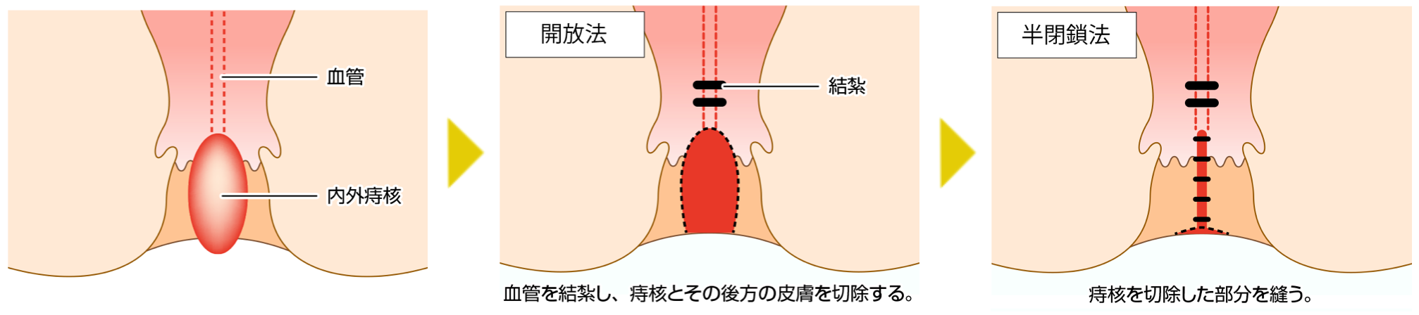 結紮切除術｜仙北市角館町で痔の手術は、下新町クリニック