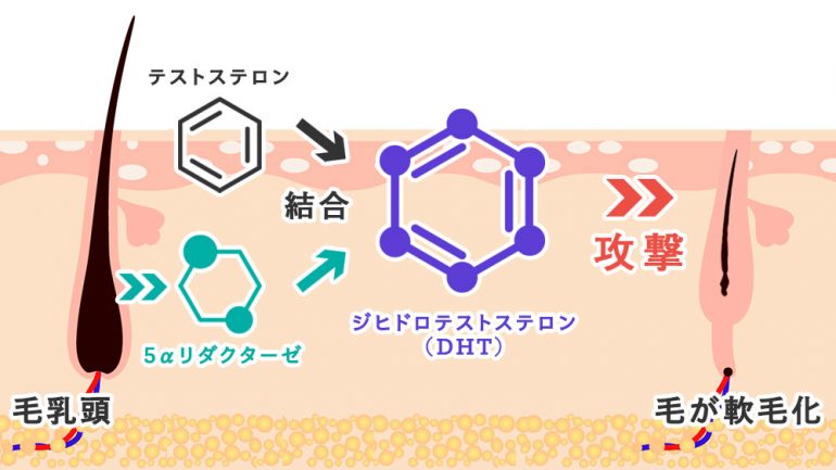 AGAの原因｜北上市の前田皮膚科クリニック